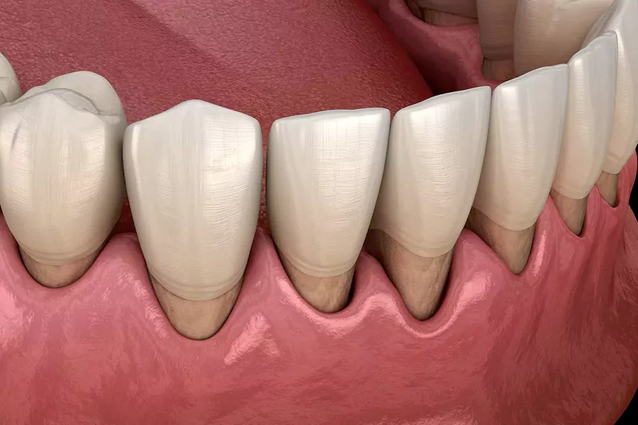 مزایای لمینت دندان