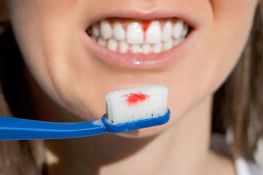 عوارض لمینت دندان